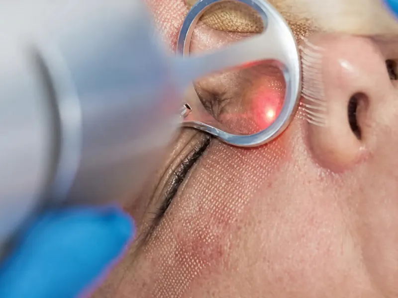 Láser CO2 fraccionado en Glow Medical Clinique