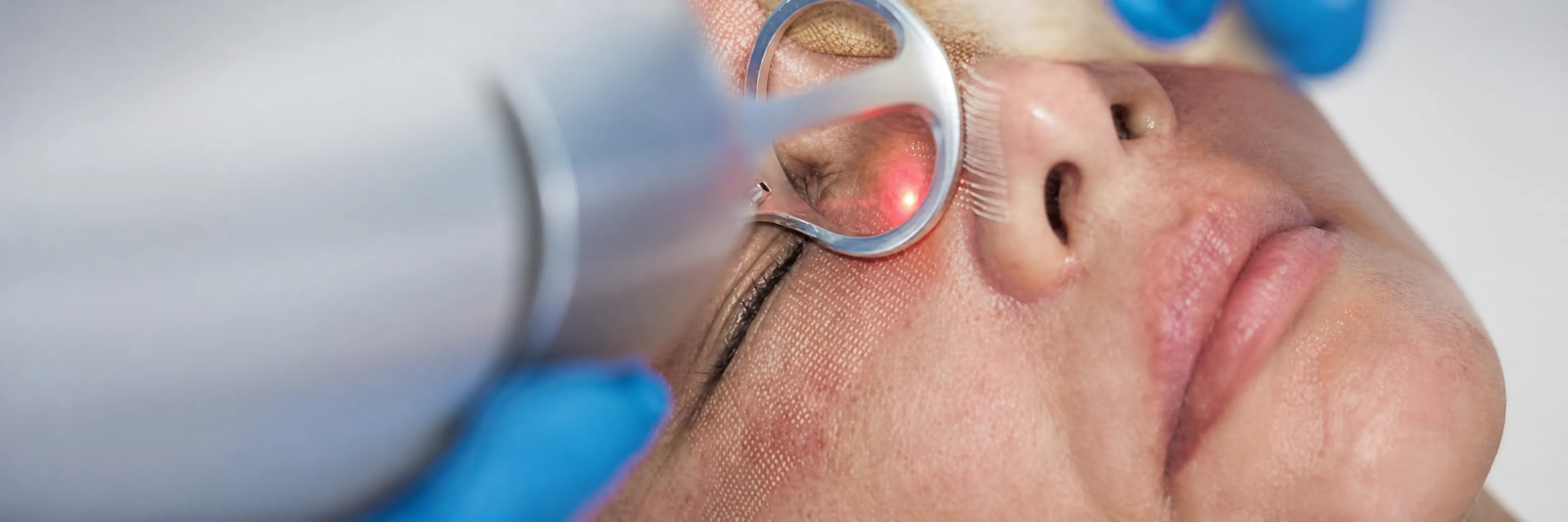 Láser CO2 fraccionado en Glow Medical Clinique