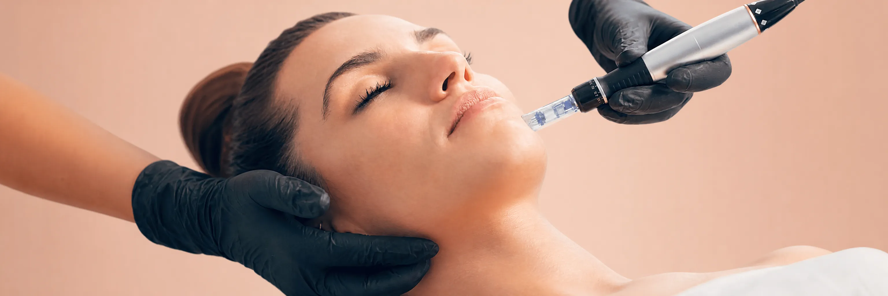 Microneedling / Microagujas (Dermapen) en Glow Medical Clinique